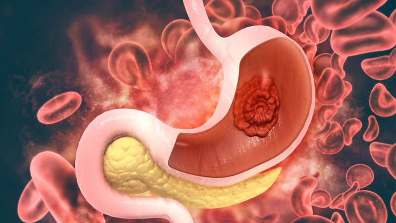 Kanker Lambung – Tanda-tanda dan Pencegahan dari PAFI Kota Barru